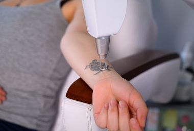 Как выбрать лазер для сведения татуировок